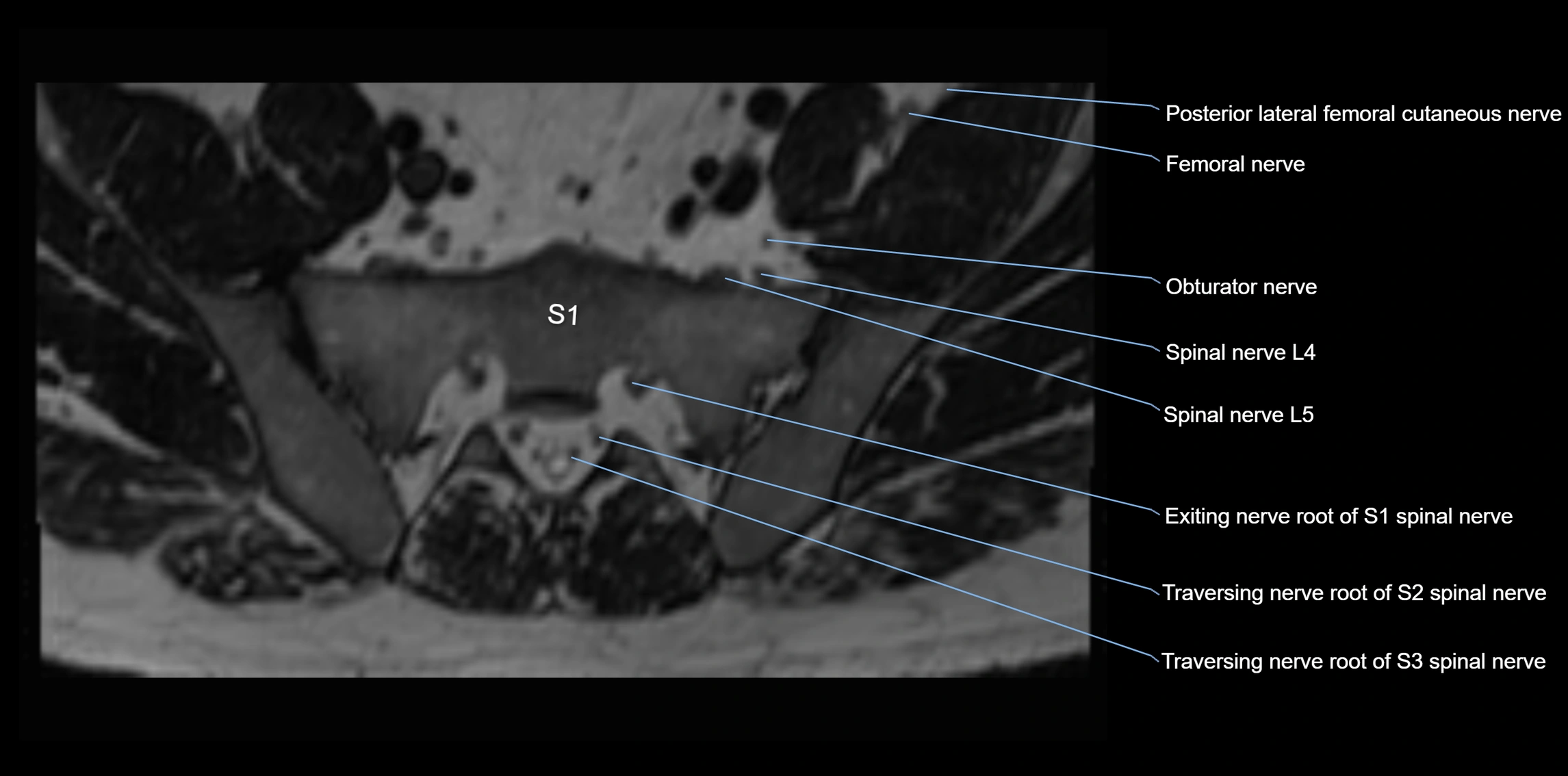 MR lumbosacral plexus axial cross sectional anatomy 3T  radiology  image-img-1008001-00075.webp